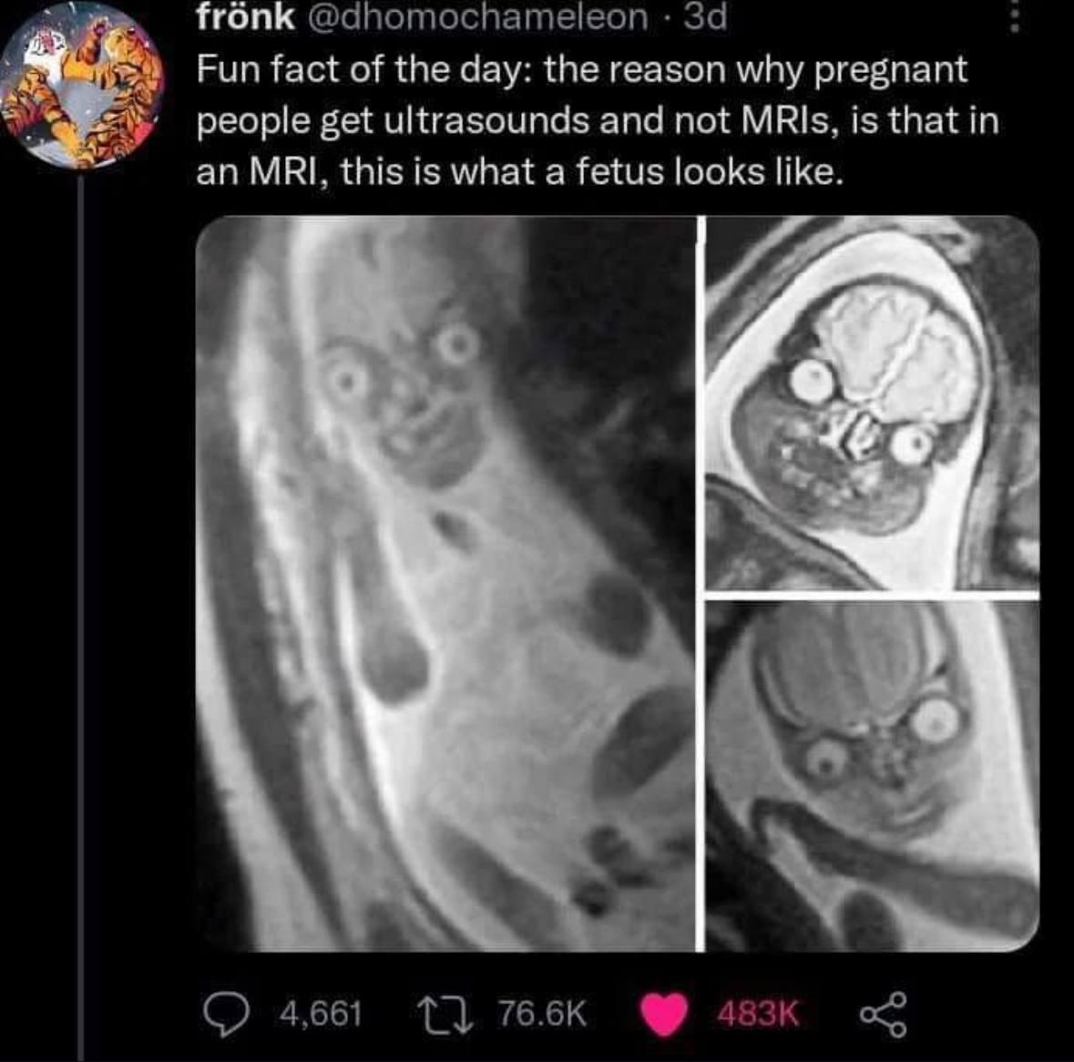 Womb With A View: When Your Unborn Child Resembles A Horror Movie Villain