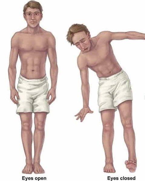 The Romberg Diagnostic Dilemma